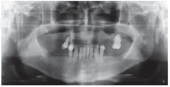 Placement of dental implants in atrophic jaw with divided crest and ...