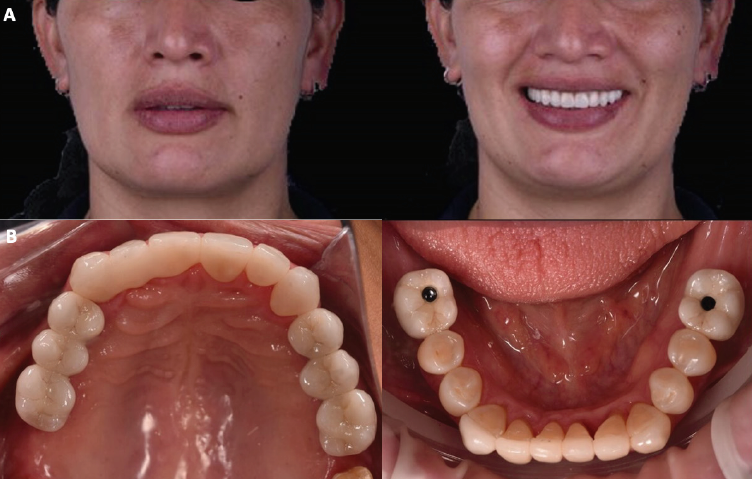 Rehabilitación oral completa de paciente con maloclusión clase II